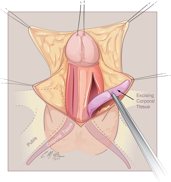 bong barrameda recommends Pictures Of Women With Large Clitoris